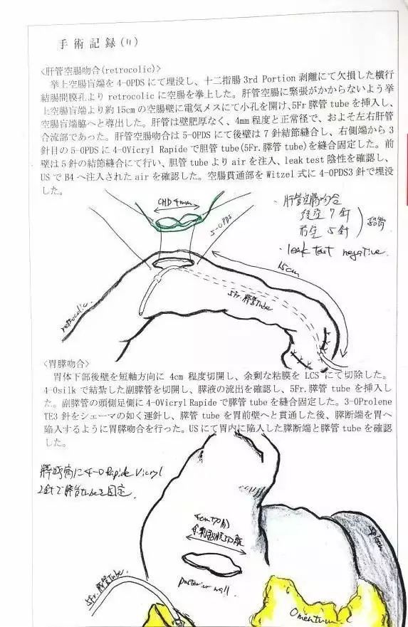 前壁5针,4-0vicryl rapide缝线固定导管,导管内注入空气测试胆瘘