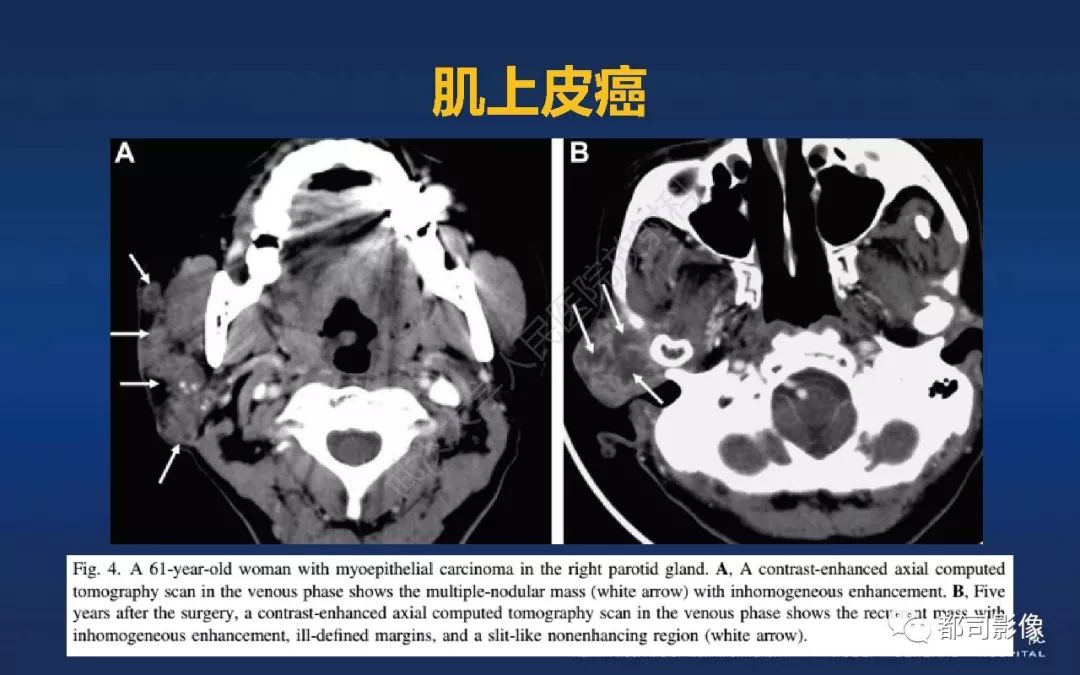 软腭肌上皮癌影像诊断