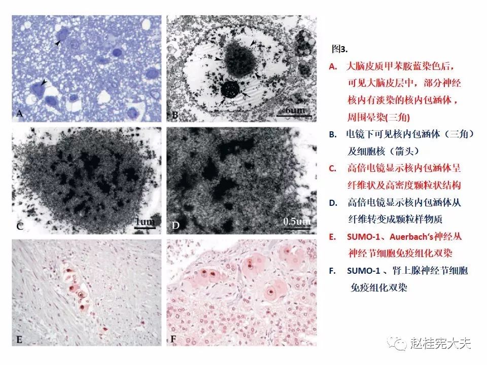 神经元核内包涵体病(niid)最新更新内容!