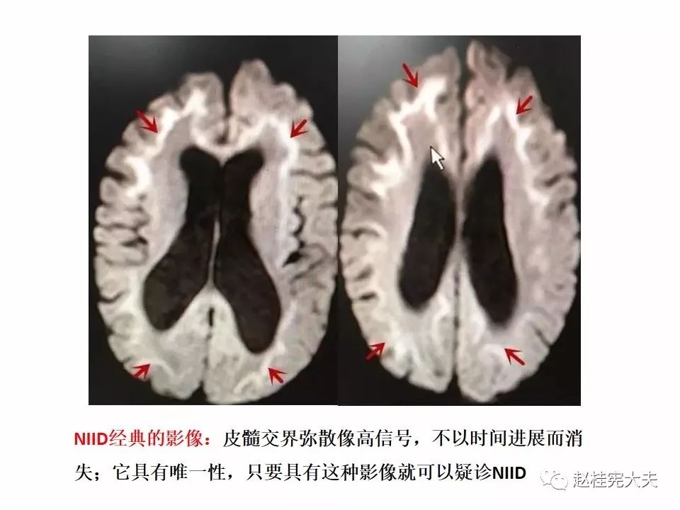 神经元核内包涵体病(niid)最新更新内容!