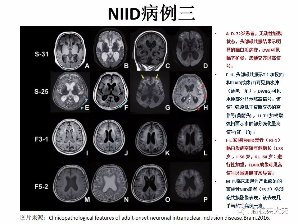 神经元核内包涵体病(niid)最新更新内容!