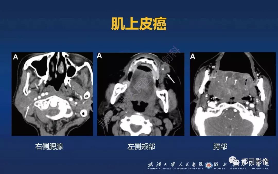 软腭肌上皮癌影像诊断