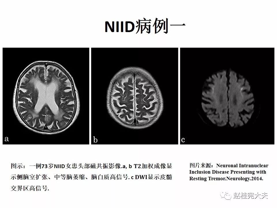 神经元核内包涵体病(niid)最新更新内容!