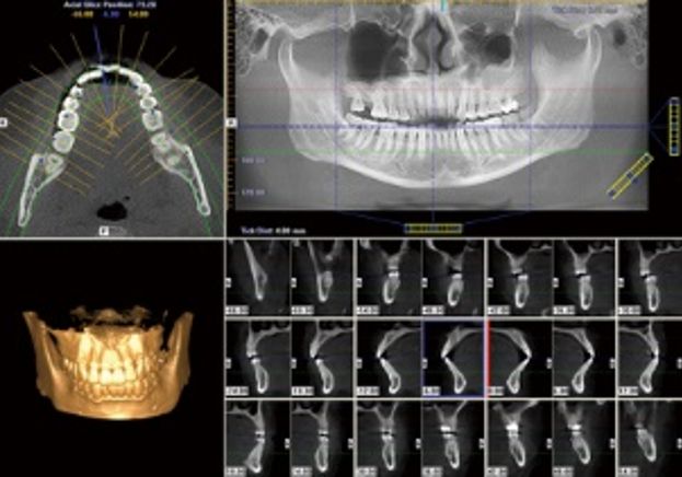 市七院口腔科引进cbct机 让牙科成像更精准