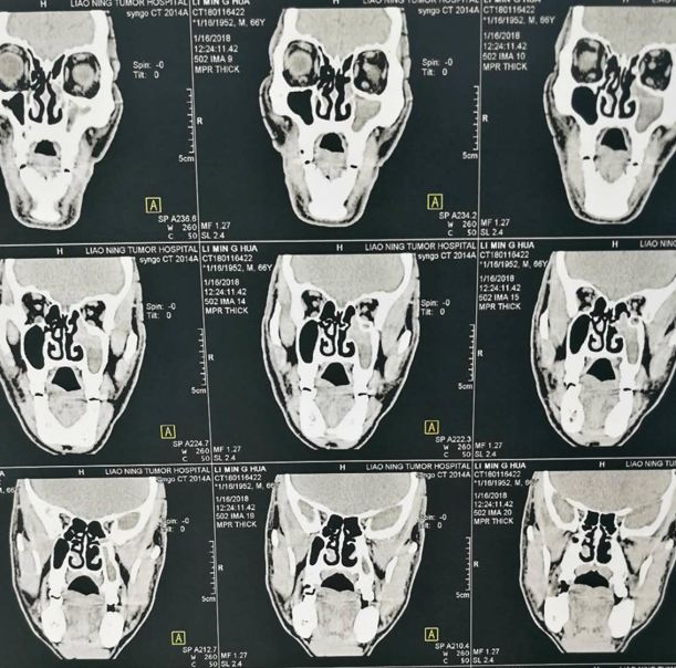 图1术前鼻窦ct