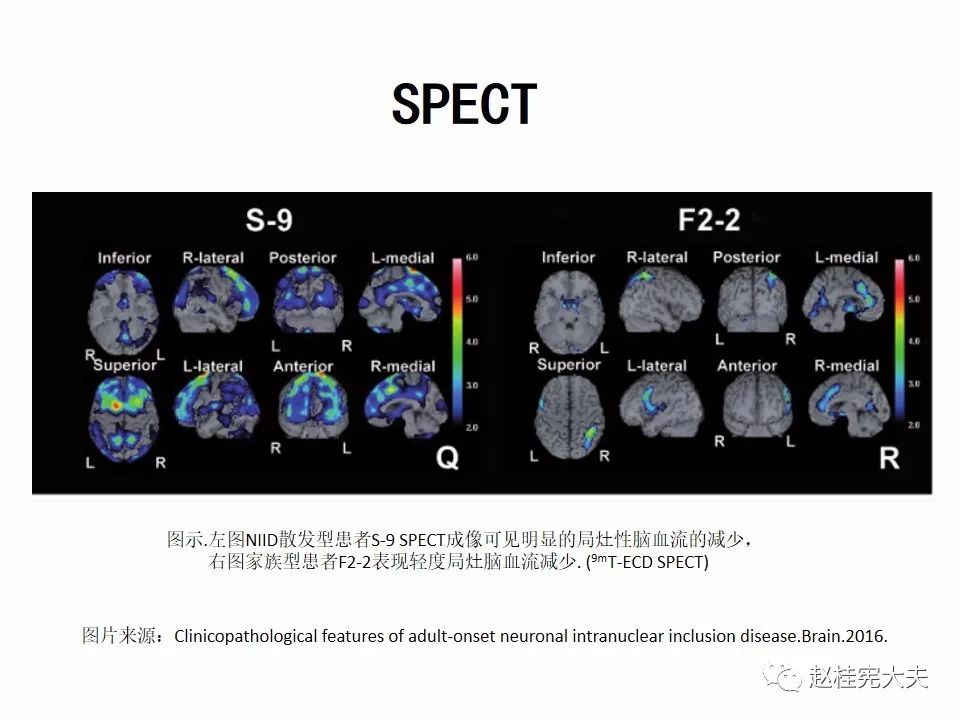 神经元核内包涵体病(niid)最新更新内容!