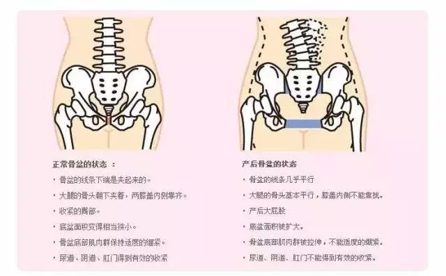 盆底肌康复与骨盆修复相生相爱