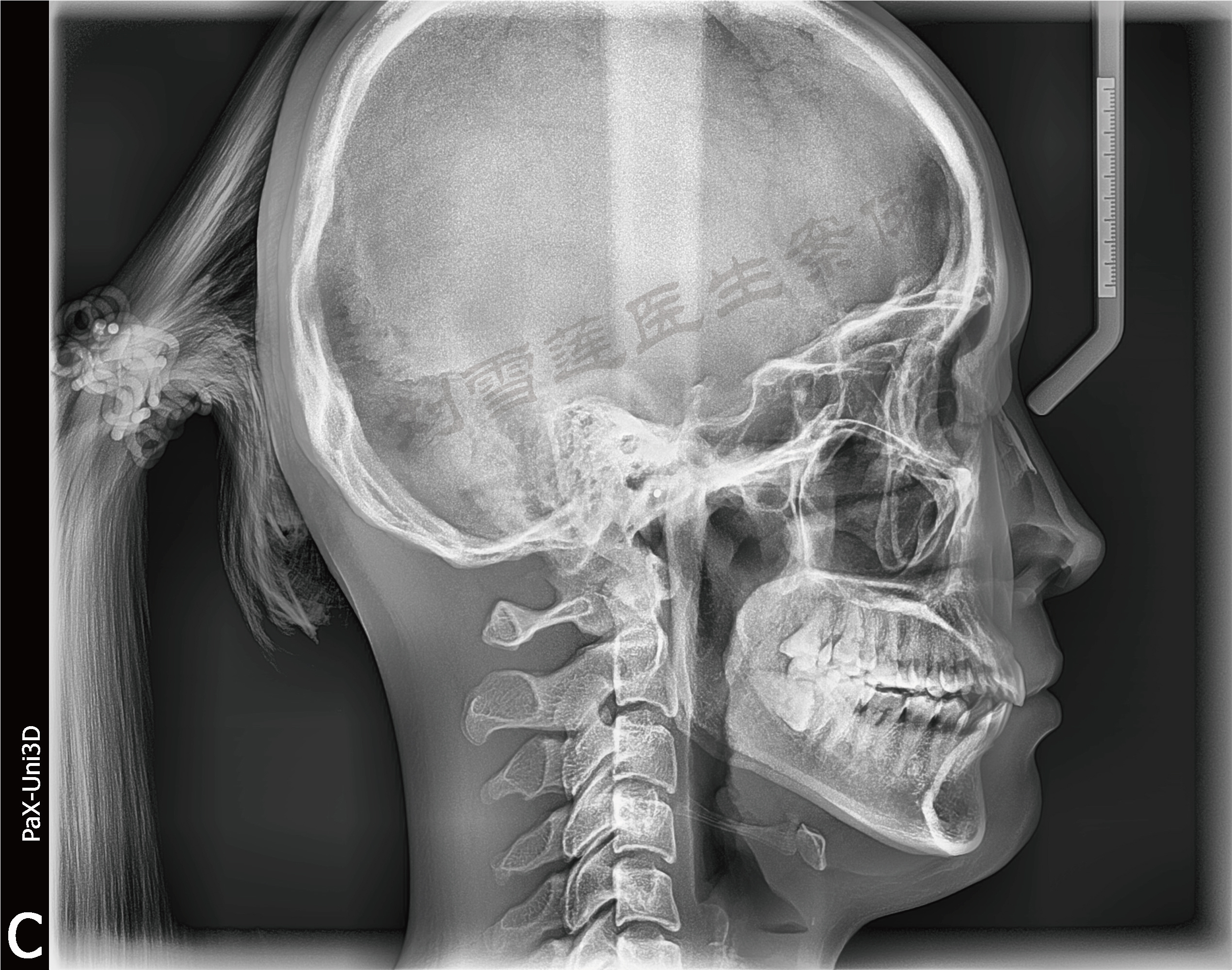 正畸医生主要通过头颅定位片来观察颅骨,颌骨的长,宽,高发育情况,并
