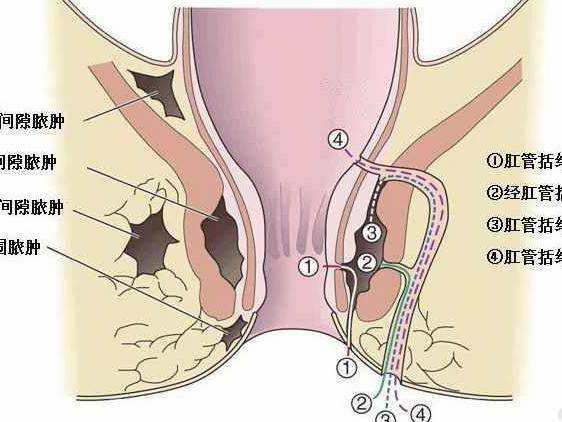 同时,要积极治疗可引起肛周脓肿的全身性疾病,如克罗恩病,溃疡性结