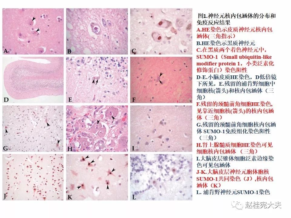 神经元核内包涵体病(niid)最新更新内容!