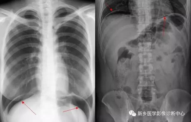 4 空腔器官穿孔3 急性胰腺炎2 急性胆囊炎1 急性阑尾炎