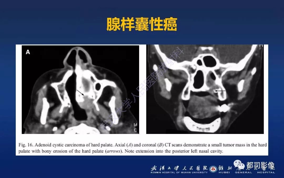 软腭肌上皮癌影像诊断