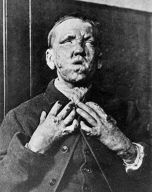 图为1891年,患结核型麻风的病人,因麻风病导致失明