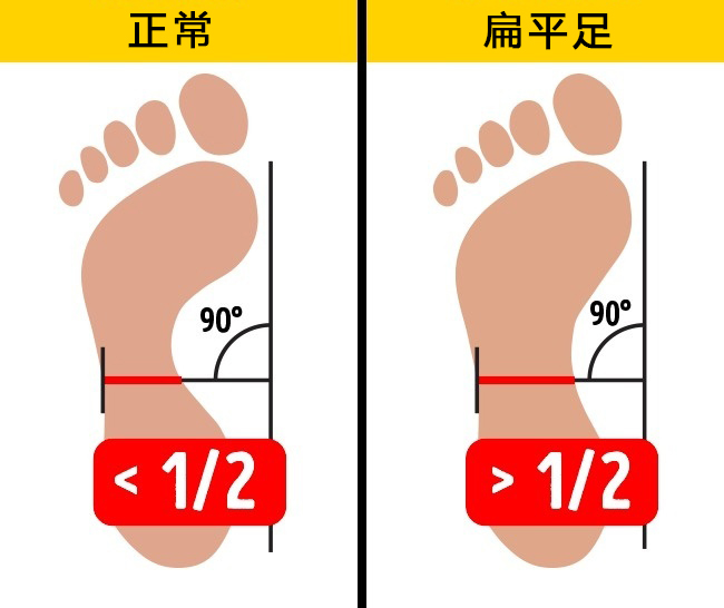 1,平脚测试如果你的扁平足有什么不适,小编提醒你:正确的诊断和治疗
