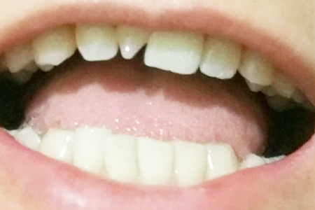 尖牙长在牙龈上怎么办
