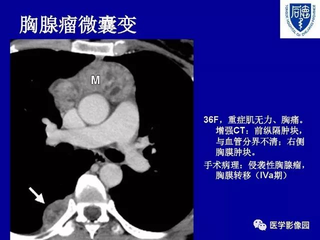 囊性胸腺瘤影像诊断与鉴别丨影像天地