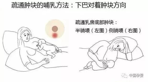 哺乳期奶管堵了怎么办