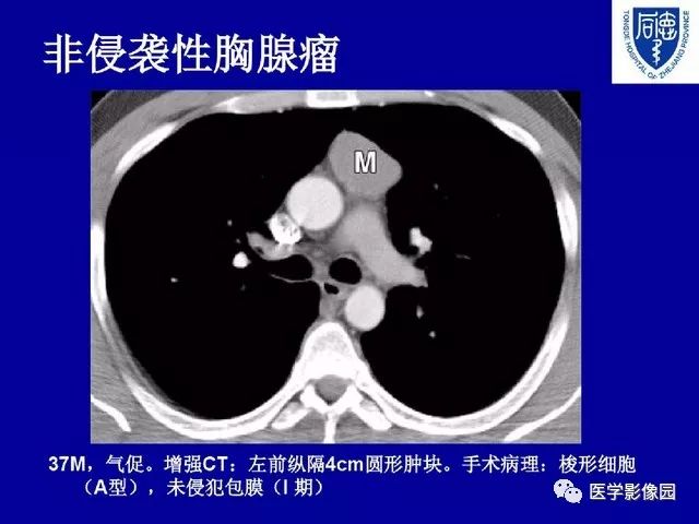 囊性胸腺瘤影像诊断与鉴别丨影像天地