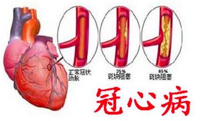 平时有什么症状就要怀疑得了冠心病