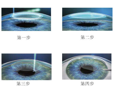 手术治疗近视眼的原理_MCT技术控制近视 非手术治疗近视的首选(3)