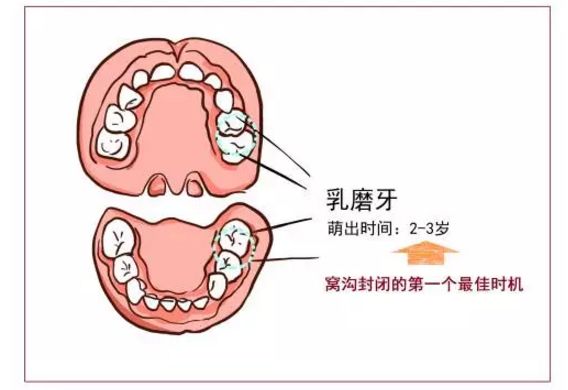 ③11-13岁时,第二恒磨牙萌出后