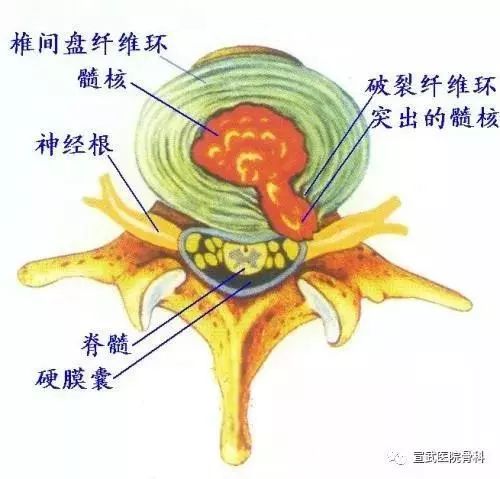 髓核突出压迫神经根引起疼痛