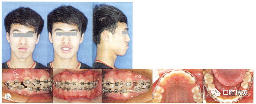 niti摇椅弓配合轻力垂直牵引矫治成人前牙严重开牙合1例报告