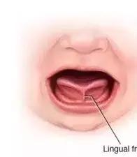 医生特别提醒了一句,判断确定舌系带是否过短最好在宝宝6个月大以后