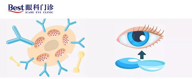 角膜塑形镜镜片常见沉淀以及处理方法