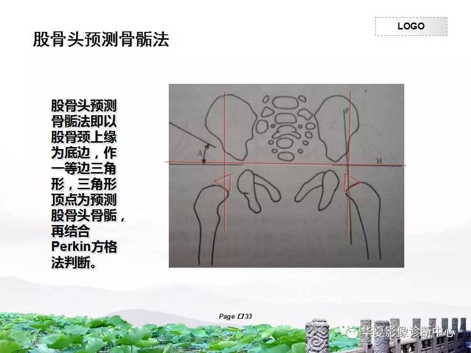 影像基础发育性髋关节脱位的影像学诊断