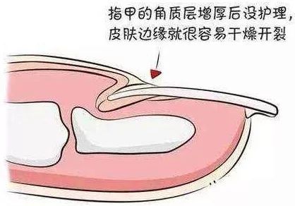 手上有倒刺别手贱随便拔被截肢可不是闹着玩的