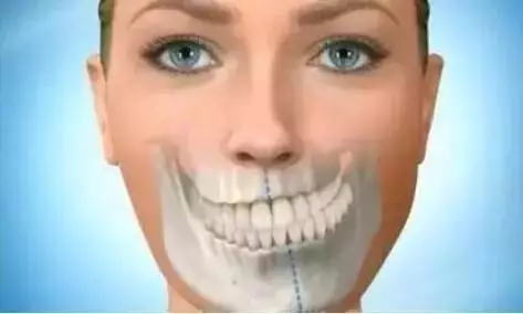 由于一边的牙齿龋坏或缺失等原因,长期用另一侧吃东西,导致双脸型不