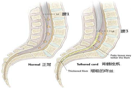 孩子得了脊髓栓系综合征应该怎么办?