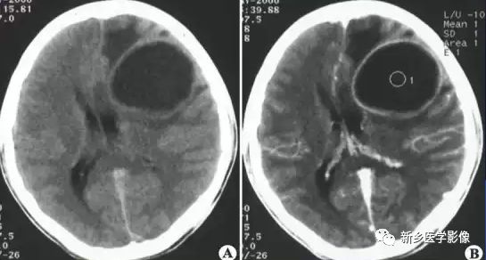 边缘光整,中央不强化,病灶周围可见明显脑水肿