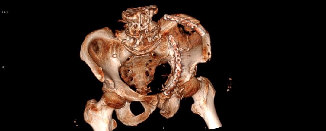 术后三维成像2骨盆骨折多为强大的外力所致.