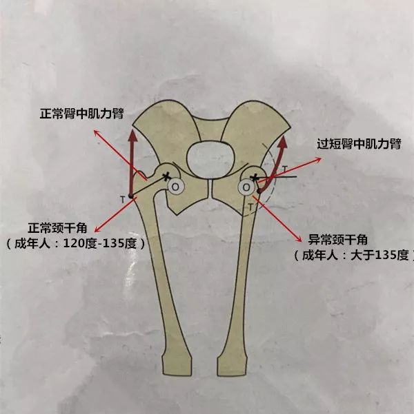 股骨颈位置的变化导致臀中肌的力臂缩短,工作效率下降.