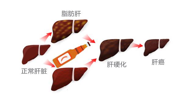 接着是酒精性肝炎 ,随后是炎症坏死,肝纤维化,肝硬化 ,最后是肝癌!