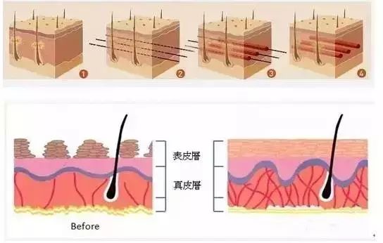 蛋白线提升的原理_蛋白线面部提升术的工作原理是什么(3)