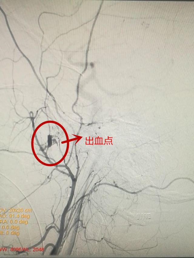 【湖南首例】失足坠楼至"七窍流血" 介入止血避免开颅