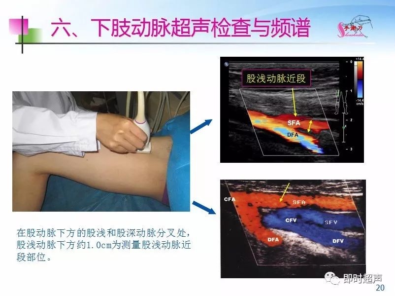 下肢血管的超声检查及正常声像图