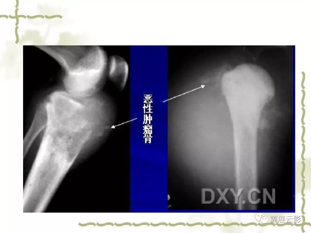 骨肿瘤诊断分析的基本要素,你都知道吗