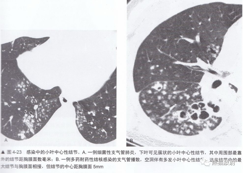 知识点丨肺多发结节之概念与评估