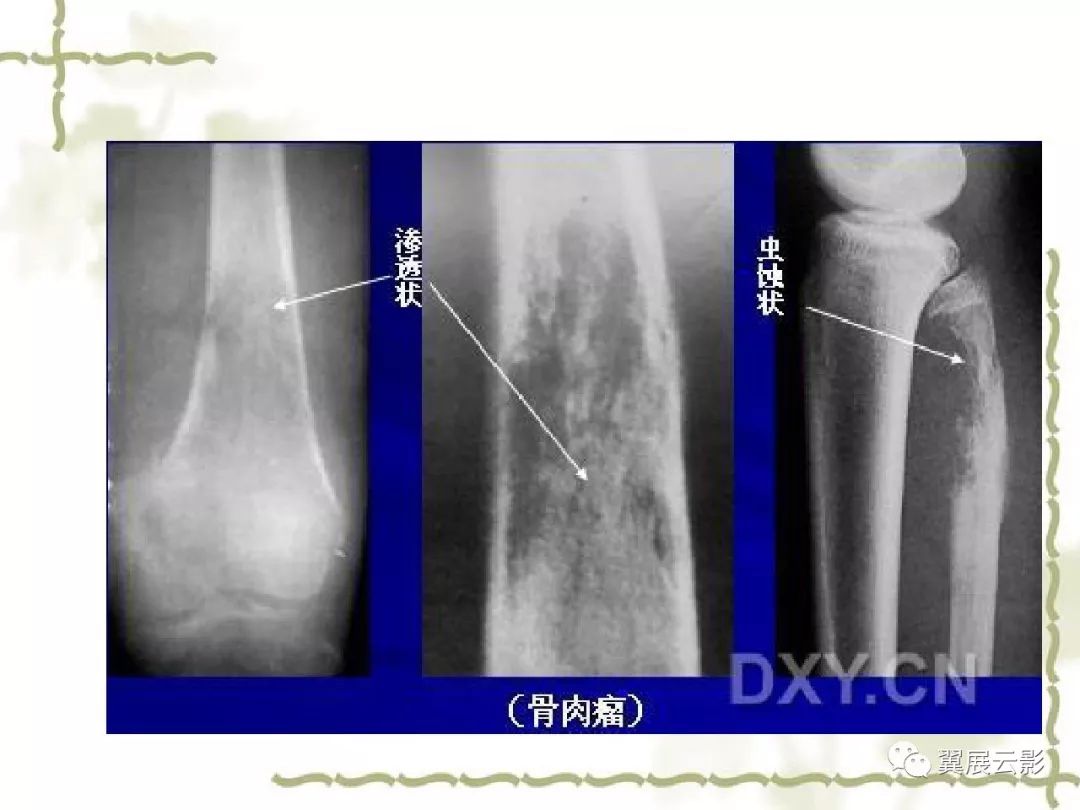 骨肿瘤诊断分析的基本要素,你都知道吗