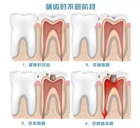 蛀牙引起的口臭怎么办