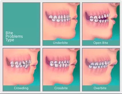 那不正常咬合就分很多种了反咬合,就是我们常说的地包天 深咬合,咬住