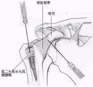 依次在确定的不同治疗部位行带刃针治疗,如做喙肱韧带的松解(见图1)