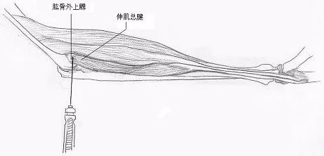 【基层中医适宜技术】中医微创—带刃针技术