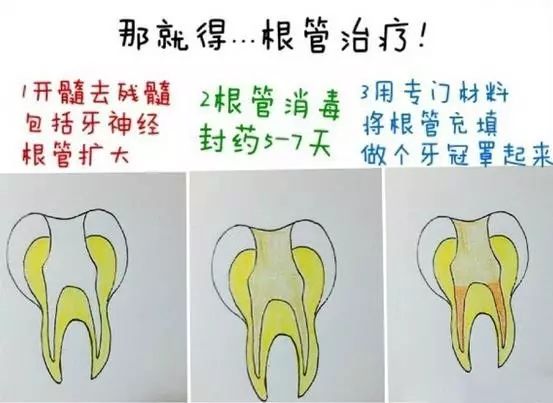 蛀牙引起的口臭怎么办