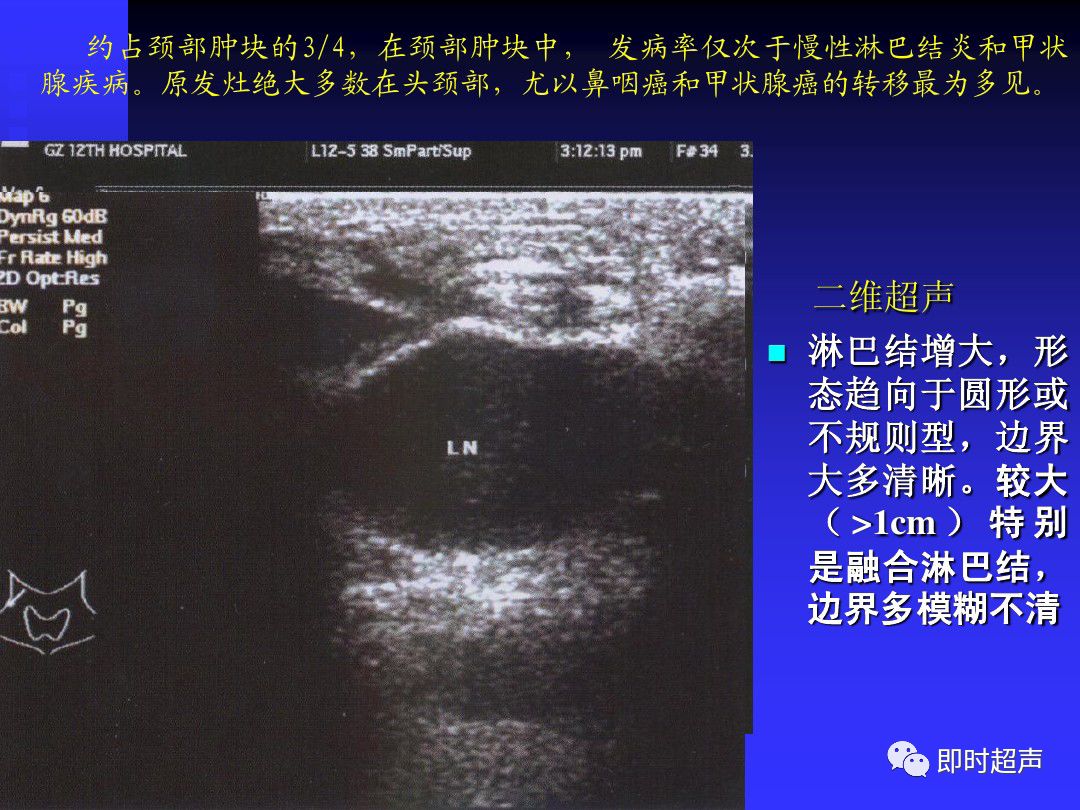 淋巴结肿大的超声诊断
