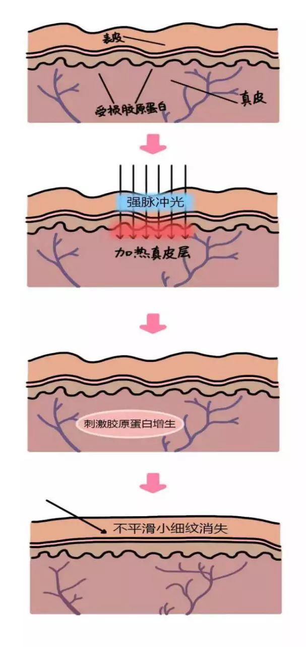 光子嫩肤技术是什么原理_光子嫩肤原理